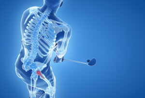 Hüftprothesen - Golfspielen mit künstlichem Gelenk ist möglich.